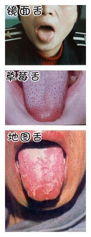吃了治胃炎的药舌头发白是什么原因